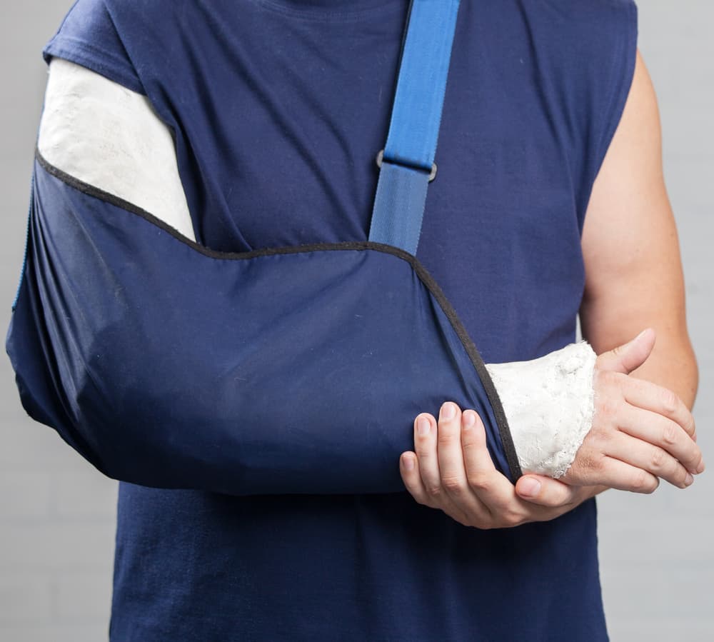 A man with a broken arm and shoulder, wearing a plaster cast, shows his injury after an accident.






